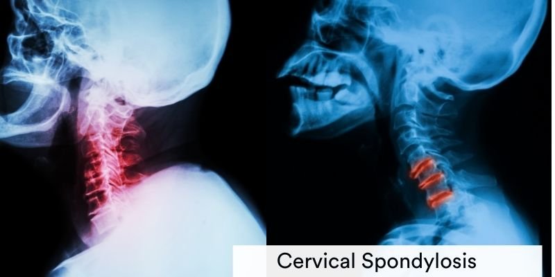 9335cervical-spondylosis.jpg